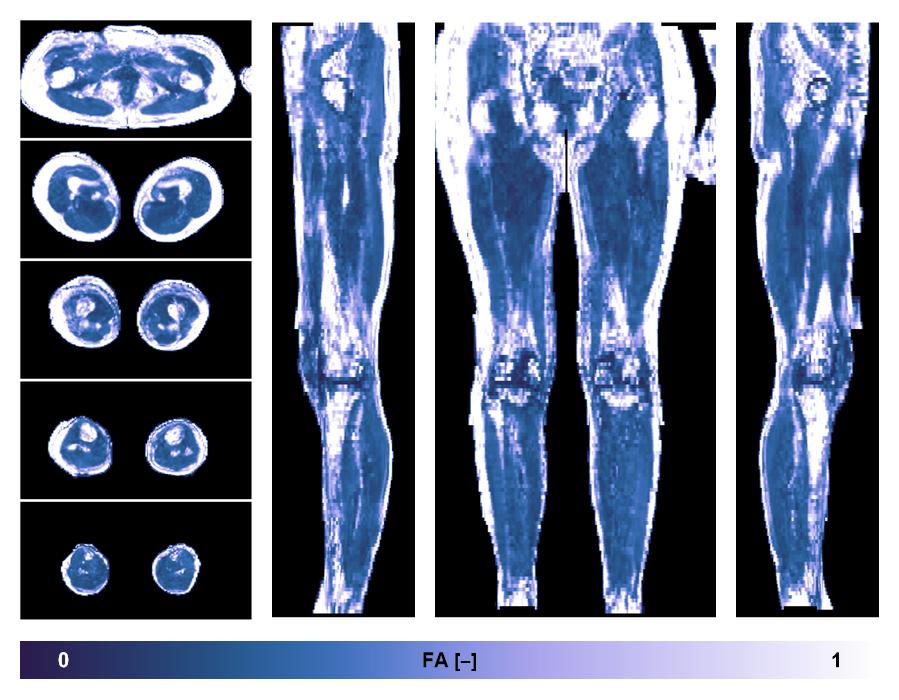 IVIM corrected whole leg muscle fractional anisotropy obtained from diffusion tensor imaging.